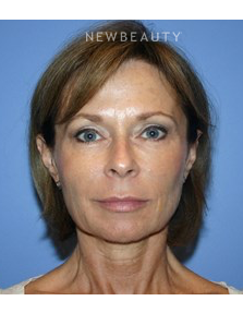 Dr. Kelly Bomer- Facelfit - After