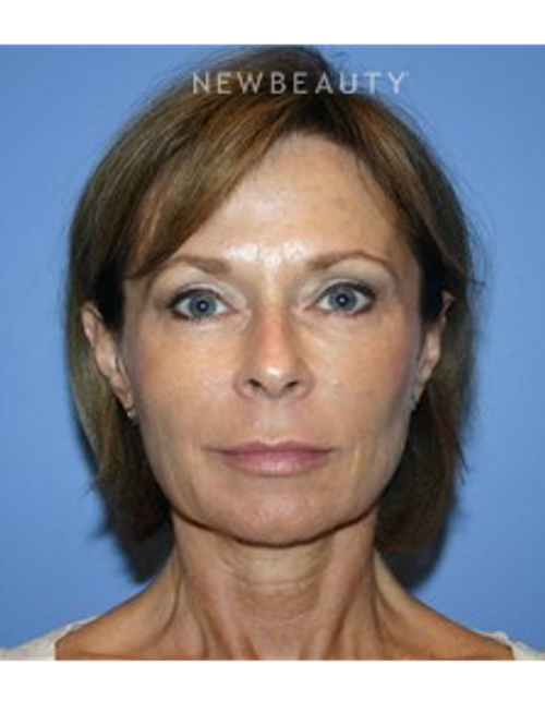 Dr. Kelly Bomer- Facelfit - After