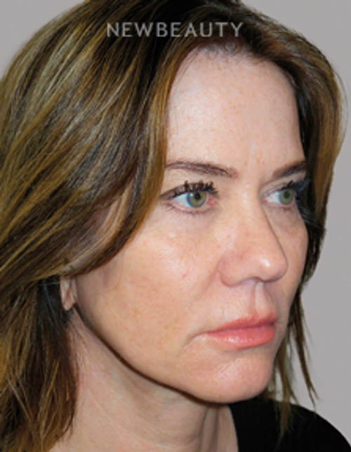Dr. Sanjay Grover - Facelift - 49726344 - After