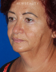 Dr. Konstantin Vasyukevich - Lower Facelift - Before