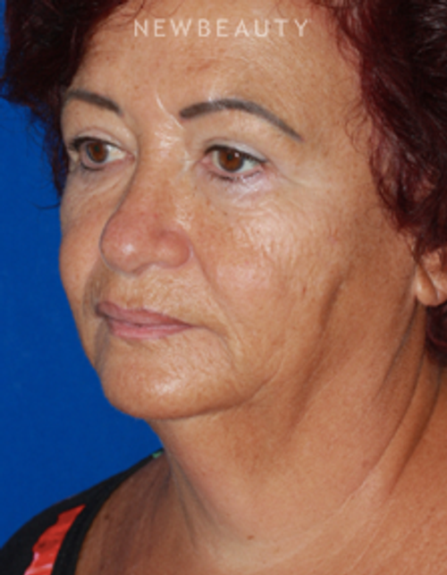Dr. Konstantin Vasyukevich - Lower Facelift - Before