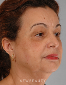 Dr. Henry Mentz Eye Lift, Facelift, Necklift - Before