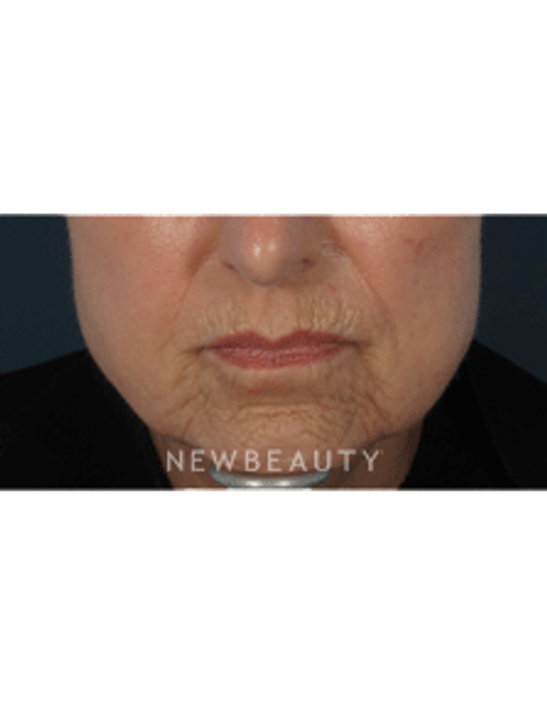 Dr. Gilly Munavalli Lasers - Before