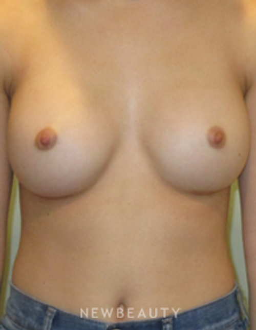 Dr. Michael Horn - Breast Augmentation - After