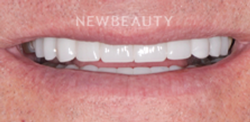 Dr. Salvator La Mastra - Smile Makeover -46107772 - After