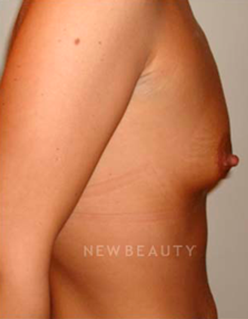 Dr. Michael Horn Saline Breast Implants - Before