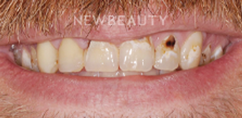Dr. Salvator La Mastra – Smile Makeover – 46107152 - Before