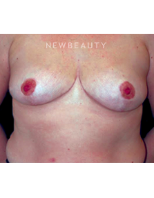 Dr. Roman Rayham - Breast Reduction - After