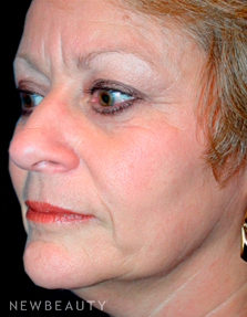 Dr. Kelly Bomer Liquid Facelift - Before