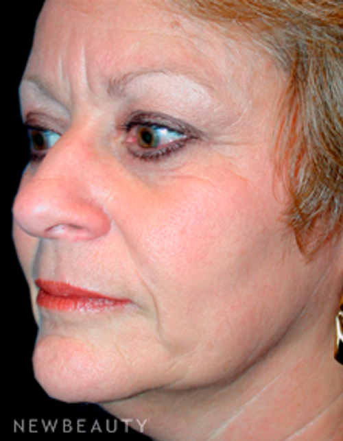 Dr. Kelly Bomer Liquid Facelift - Before