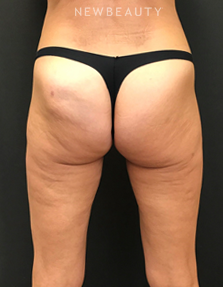 Dr. Janet Allenby - EmSculpt - Before