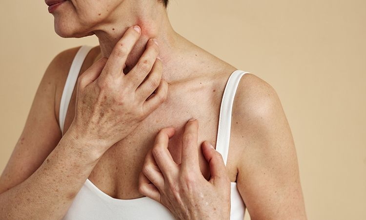 Close up of adult woman scratching neck suffering from itch and allergies, copy space