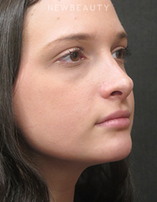 Dr. Elie Levine - Liposuction - After