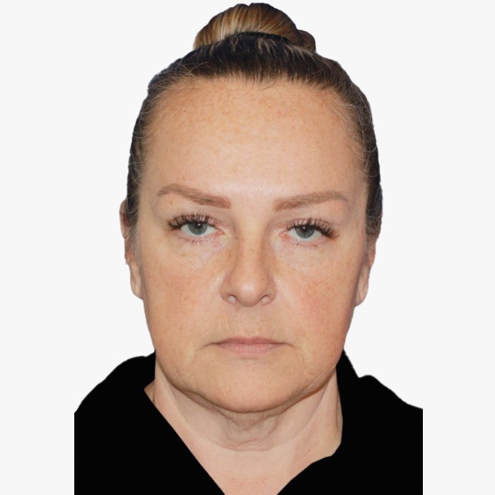 before facelift necklift