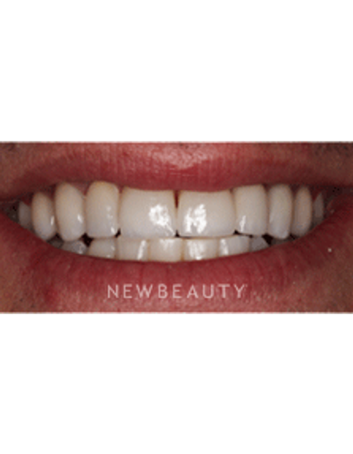 Dr. Neal Patel Smile Makeover - After