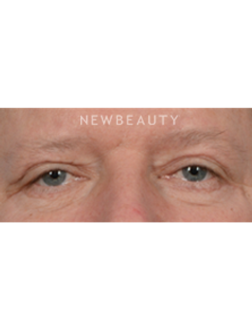 Dr. Jeffrey B. Wise - Upper Blepharoplasty - After