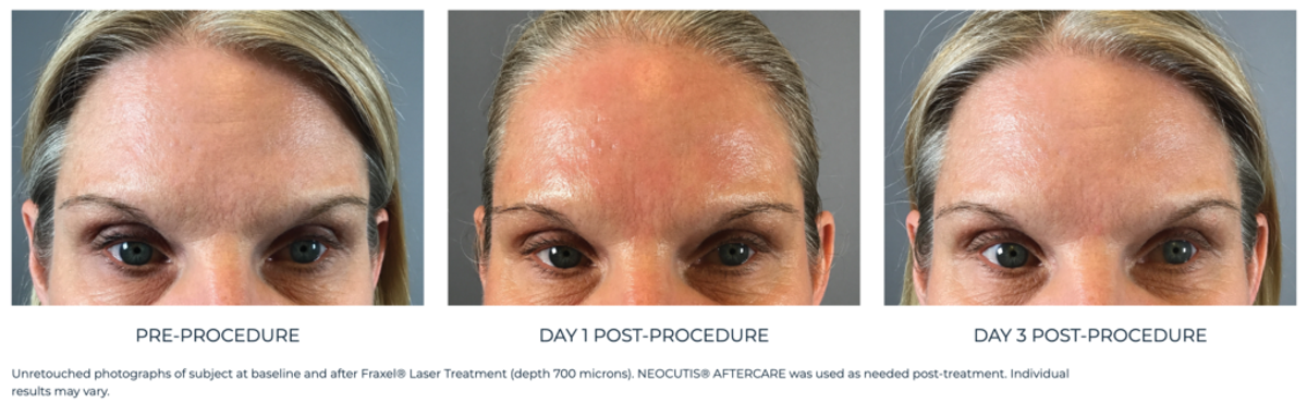 neocutis aftercare before-and-after results