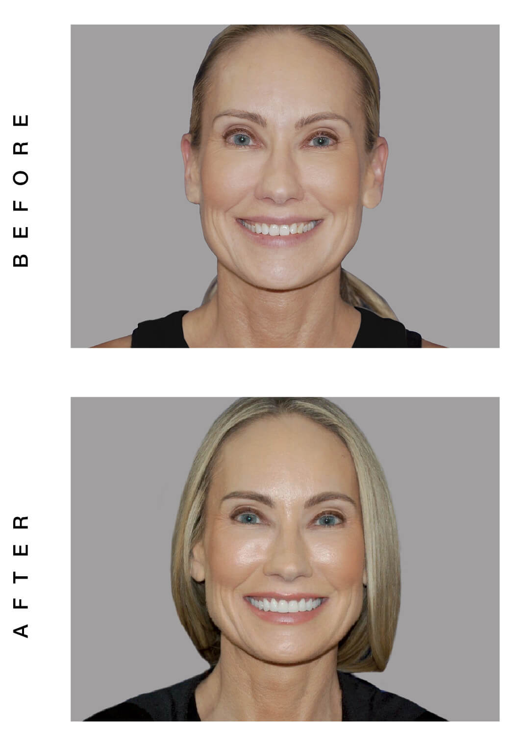 smile makeover before and after