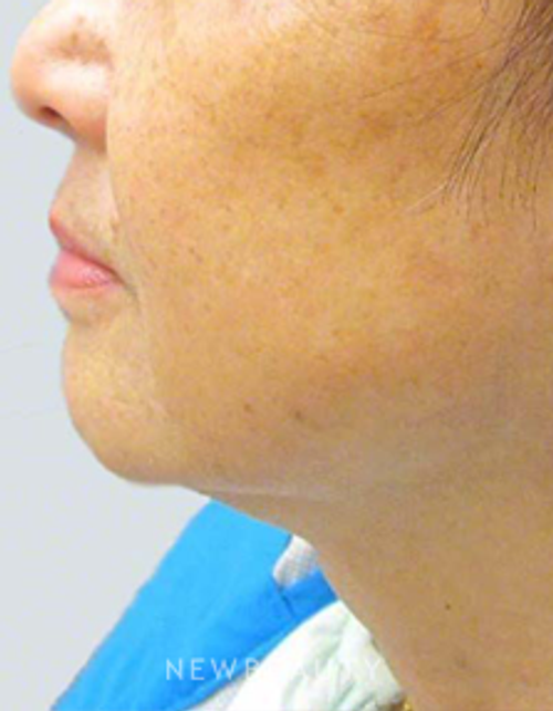 Dr. Kally Papantoniou - Ulthera - After