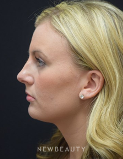 Dr. Jeffrey B. Wise - Rhinoplasty - Before
