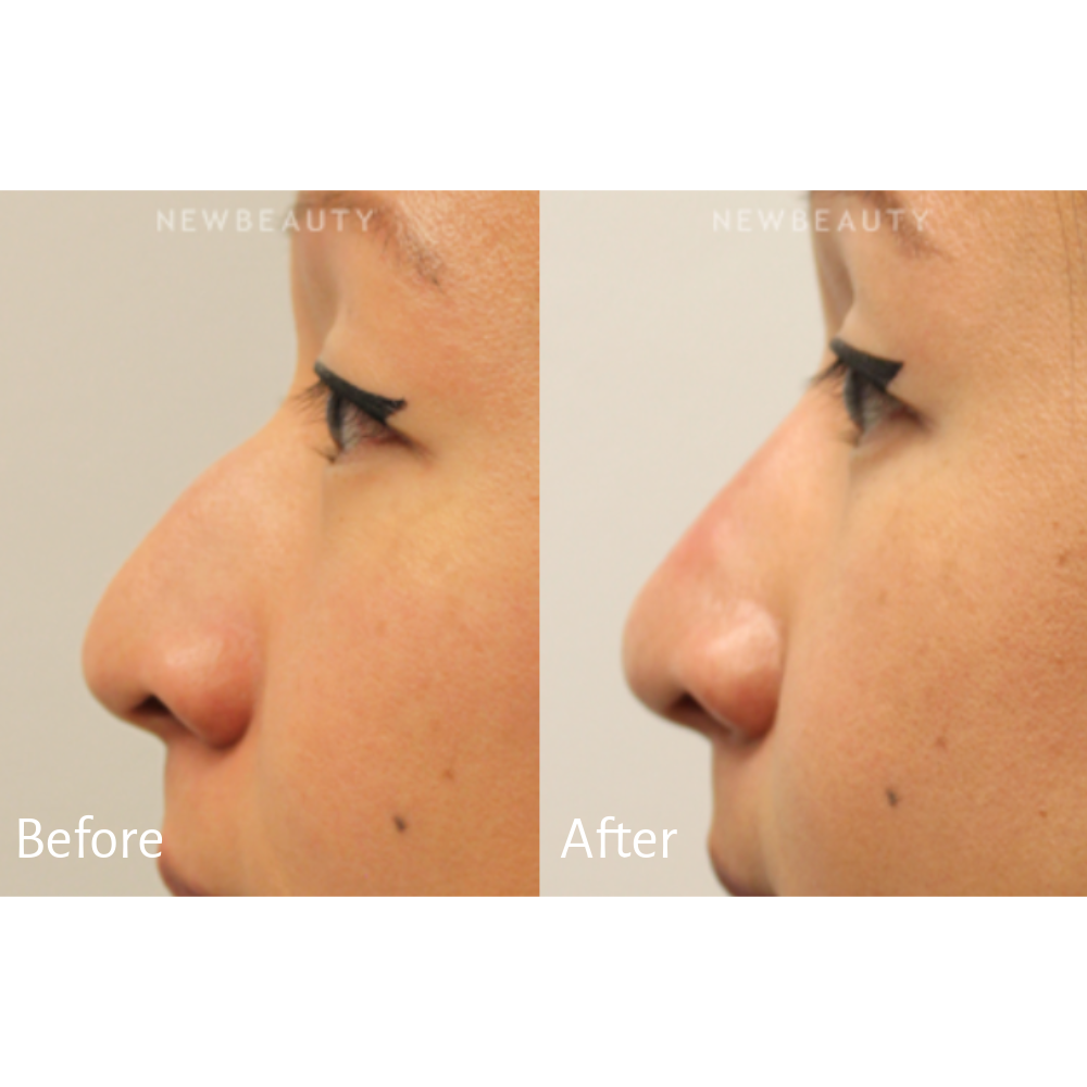 Treatment: Non-surgical rhinoplasty