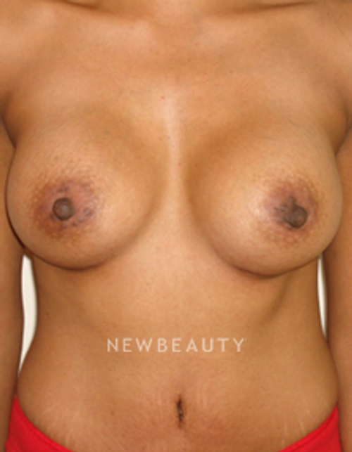 Dr. Michael Horn Breast Augmentation - After