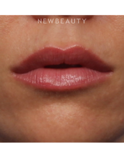 Dr. Kelly Bomer - Lip Enhancement - After