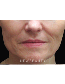 Dr. Jody Levine Injectables & FIllers - Before