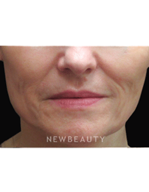 Dr. Jody Levine Injectables & FIllers - Before