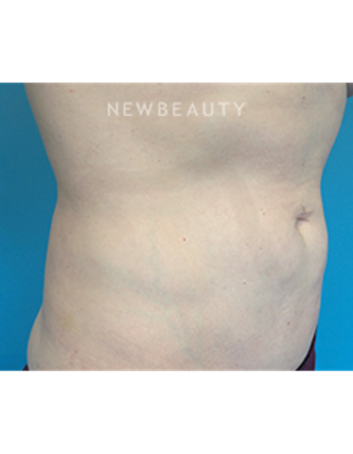 Dr. Christine Hamori - Liposuction - After