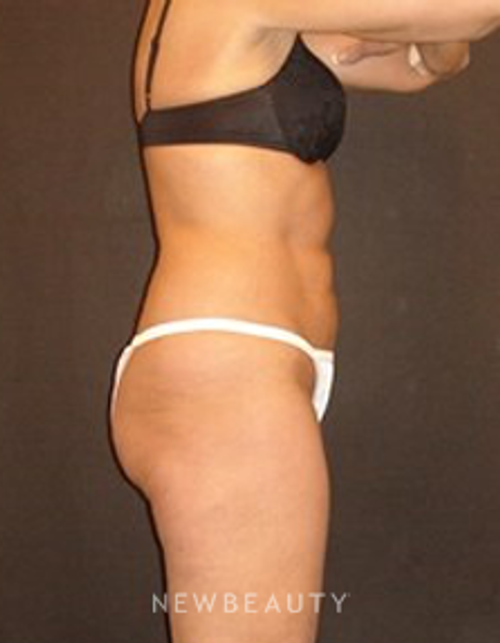 Dr. Joel Schlessinger - SmartLipo - After