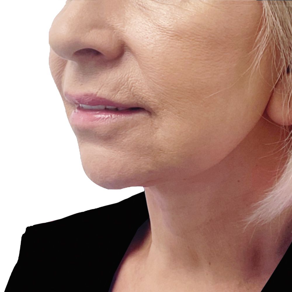 after deep-plane facelift and necklift