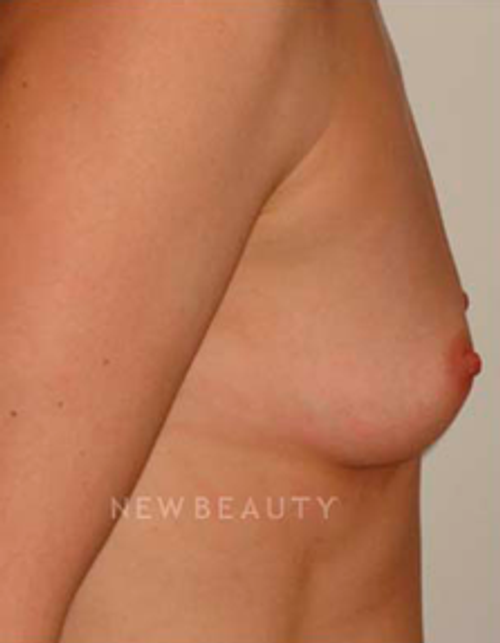 Dr. Michael Horn Breast Augmentation - Before