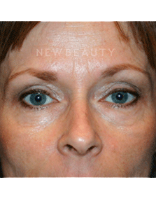 Dr. Kelly Bomer Liquid Facelift - Before