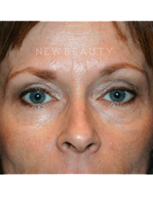 Dr. Kelly Bomer Liquid Facelift - Before