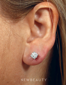 Dr. Kenneth Beer - Ear Repair - After