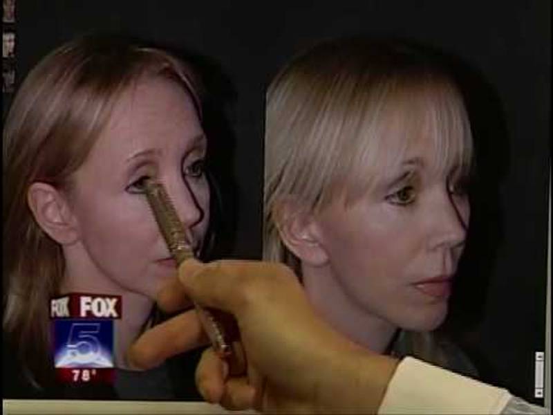 Dr. Jacono – A New York Revision Rhinoplasty Specialist