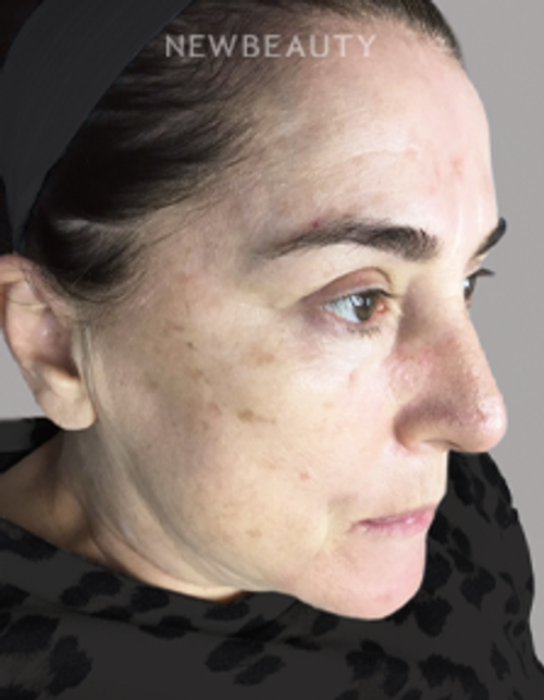 Drs. Elias - Age Spot Remover - 21781149 - Before