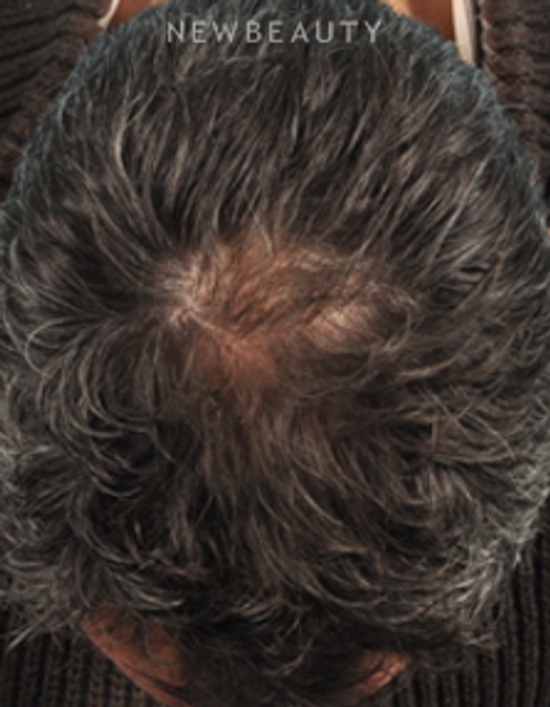 Dr. Bradley Bengtson - Hair Loss Treatment - After