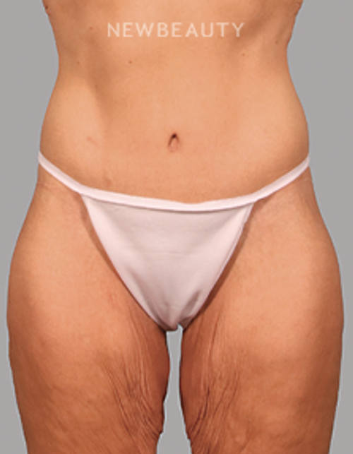 Dr. Carmen Kavali - Beautiful Transformation - 45242669 - After