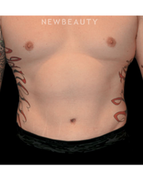 Dr. Bryan W. Gawley - A Tighter Midsection - After