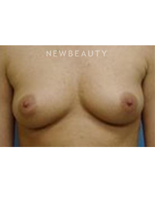 Dr. Roman Rayham - Breast Augmentation - Before