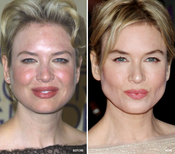 8 Celebs Who Fixed Their Skin Renee Zellweger