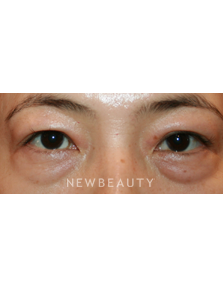 Dr. John Kang - Lower Blepharoplasty - Before