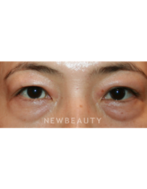 Dr. John Kang - Lower Blepharoplasty - Before