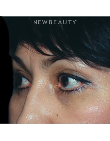 Dr. Roman Rayham - Restoring a Natural Look - After