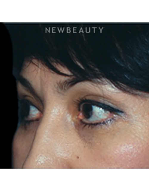 Dr. Roman Rayham - Restoring a Natural Look - After