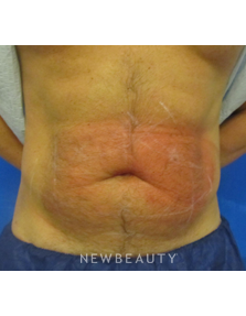 Dr. Edward Kwak - CoolSculpting - Before