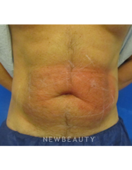 Dr. Edward Kwak - CoolSculpting - Before