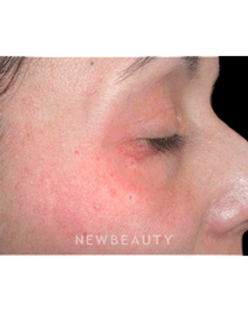 Dr. Marina Peredo Elos Lasers - After